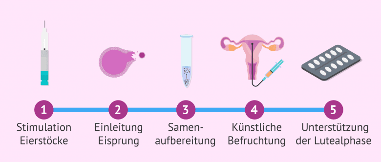 Künstliche Befruchtung: Methoden, Ablauf, Kosten Und Risiken