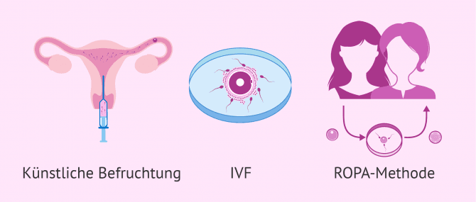 Imagen: Kinderwunschbehandlungen für lesbische Pärchen