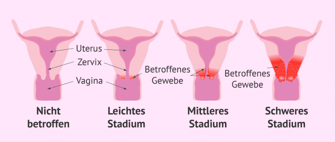 die-verschiedenen-stadien-des-zervixkarzinoms