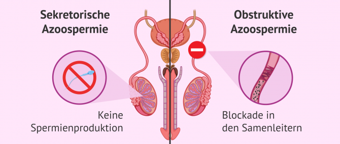 Imagen: Unterschied zwischen Typen von Azoospermie